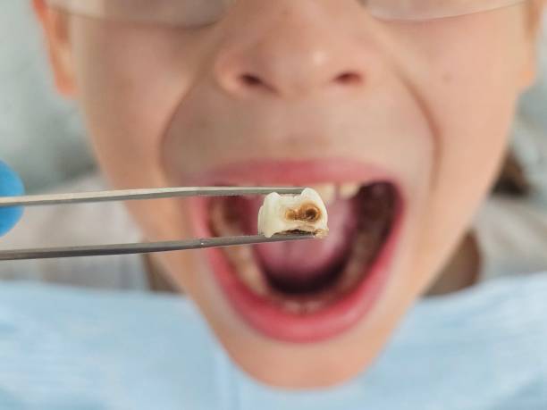 Best Emergency Tooth Extraction in Hattiesburg, MS